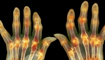 Doenças reumatológicas com acometimento neurológico