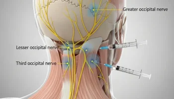 bloqueios-anestesicos-do-nervo-occipital
